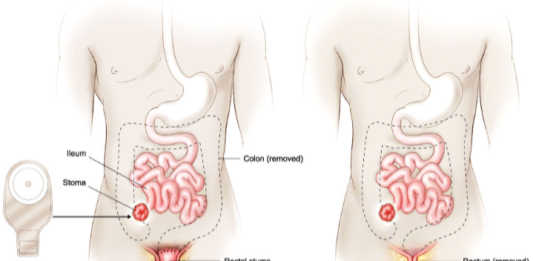 ileostoma
