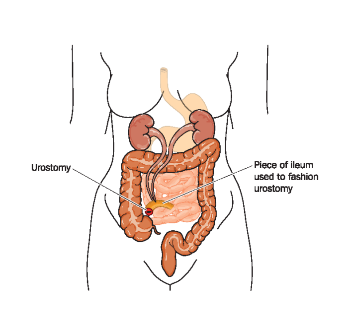 urostoma
